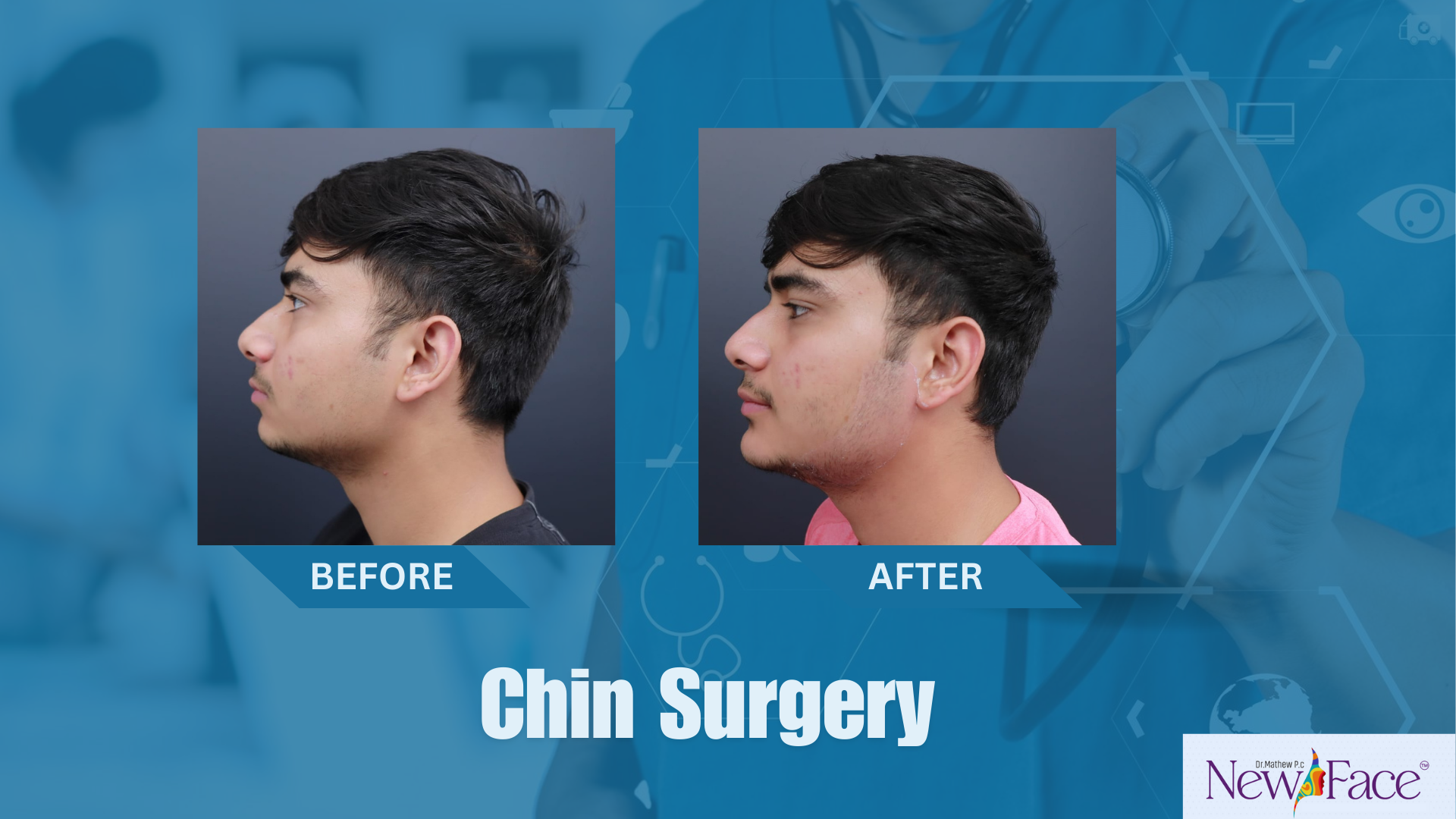 genioplasty in india dr mathew pc