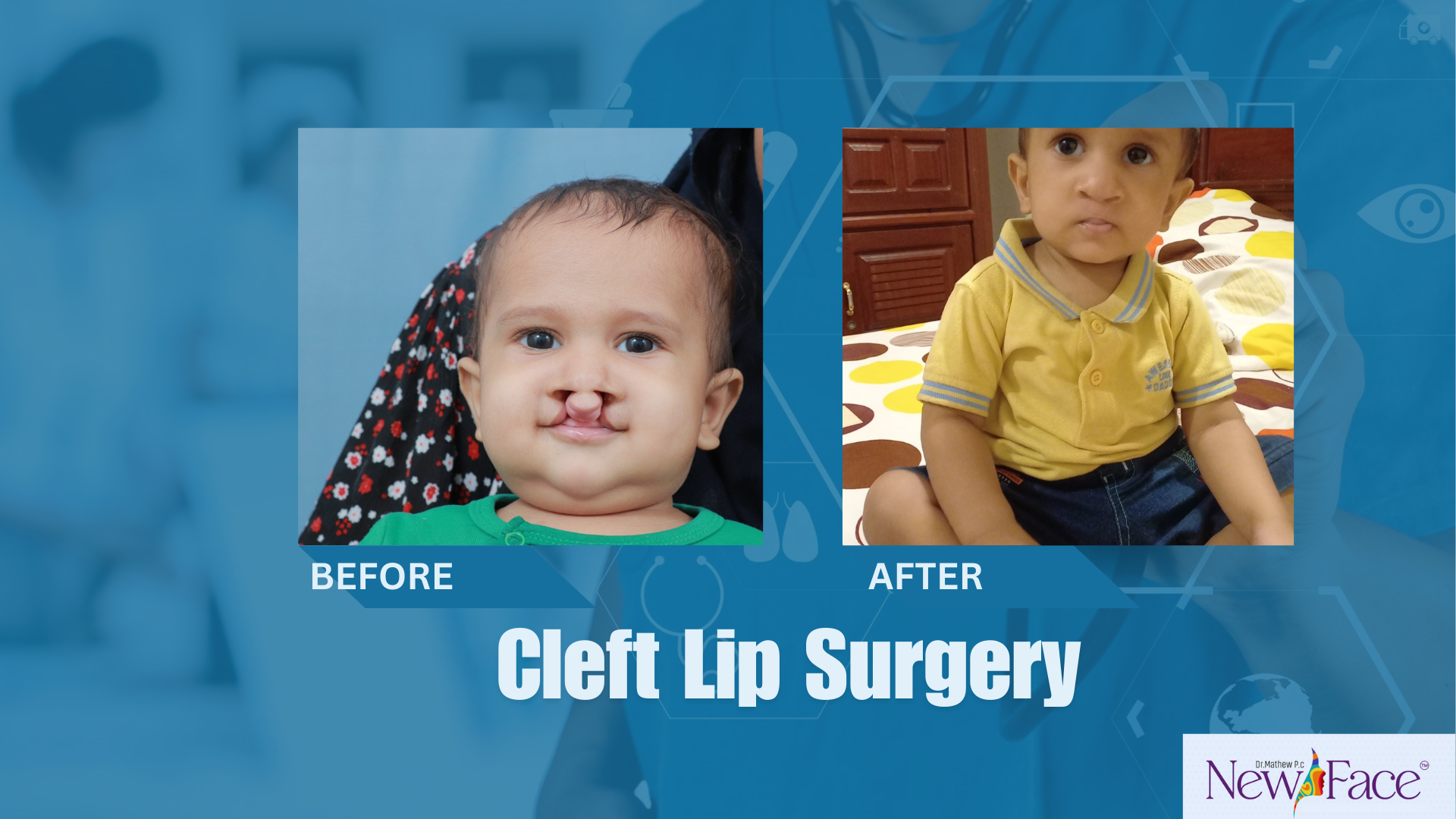 cleft lip surgery in kerala