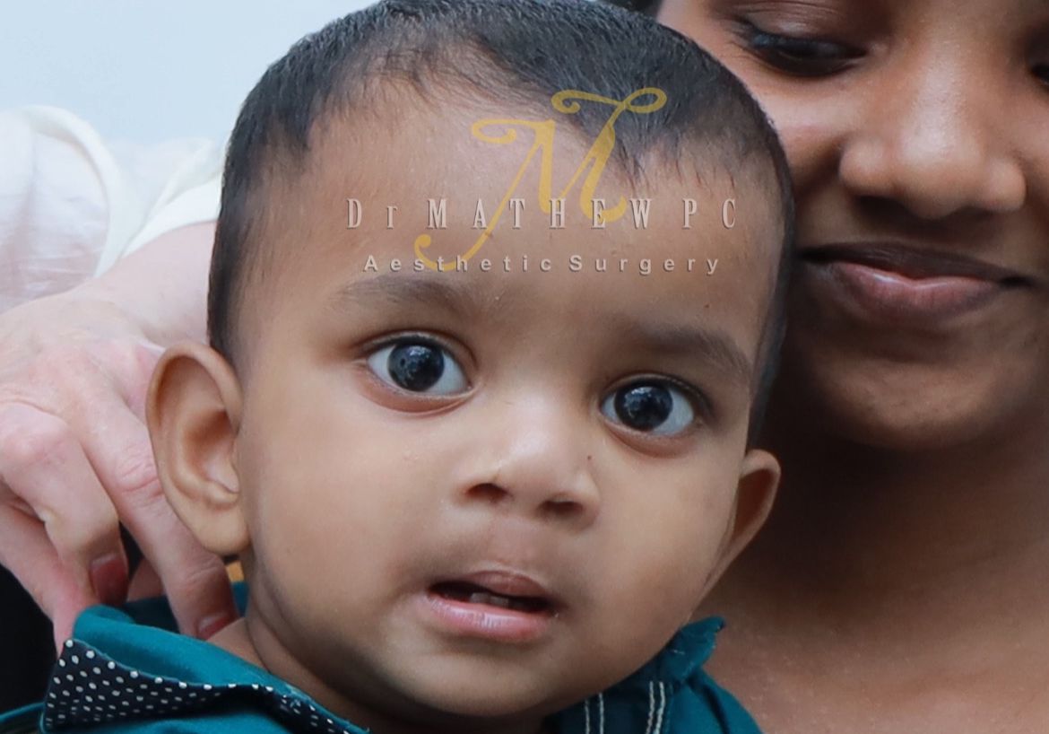 cleft lip surgery in kerala