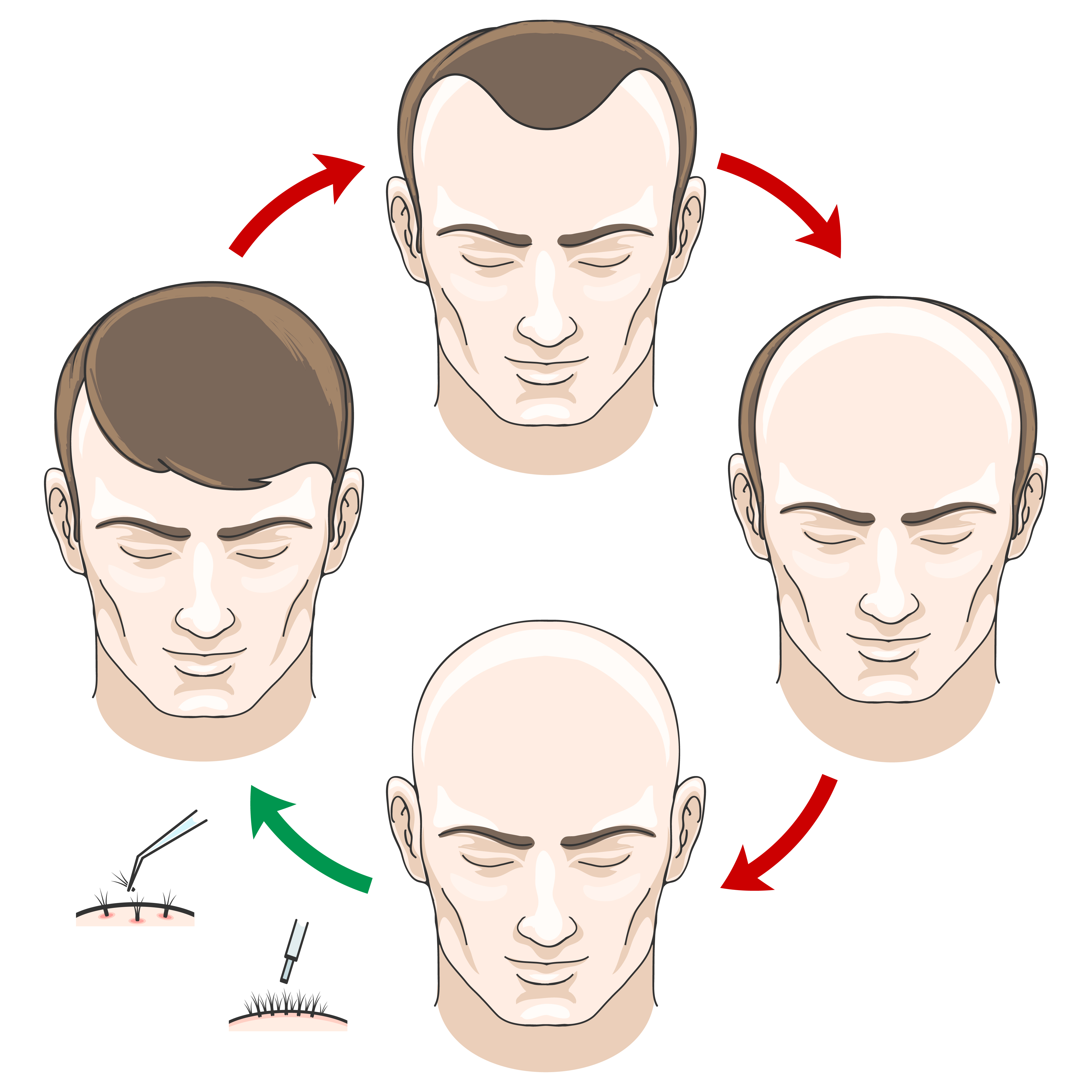 PRP hair regrowth in India