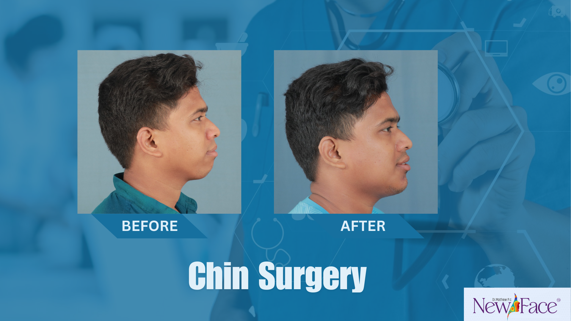 benefits of chin surgery